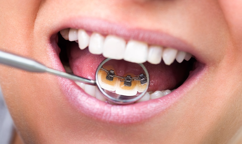 Mắc cài được gắn ở mặt trong răng